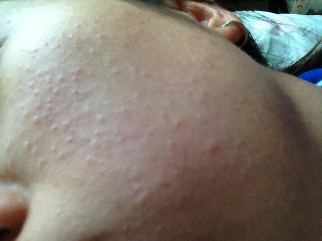 rash bumps on face #11