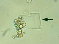 کریستال کلسترول