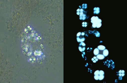 سلولهای چربی در ادرار در میکروکوپ پلاریزه