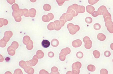 پدیده رولکس (سکه ای خودمون ) . لنفوسیت کوچک در وسط میدان