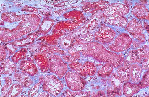 کست گلبول های قرمز