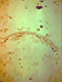 گلبول قرمز در ادرار