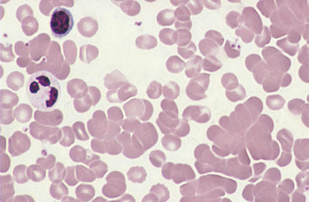 لخته شدن گلبولها . لنفوسیت کوچک و نوتروفیل هایپرسیگمانته در گوشه بالا سمت چپ