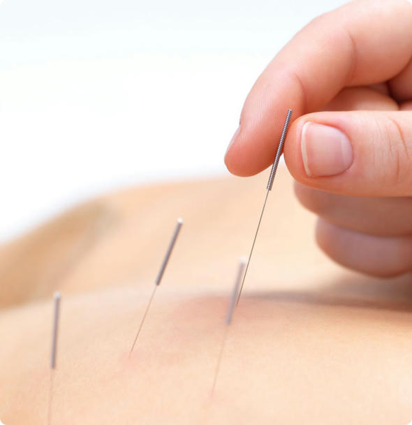 Satori Acupuncture Jupiter, FL Acupuncture Clinic, Traditional