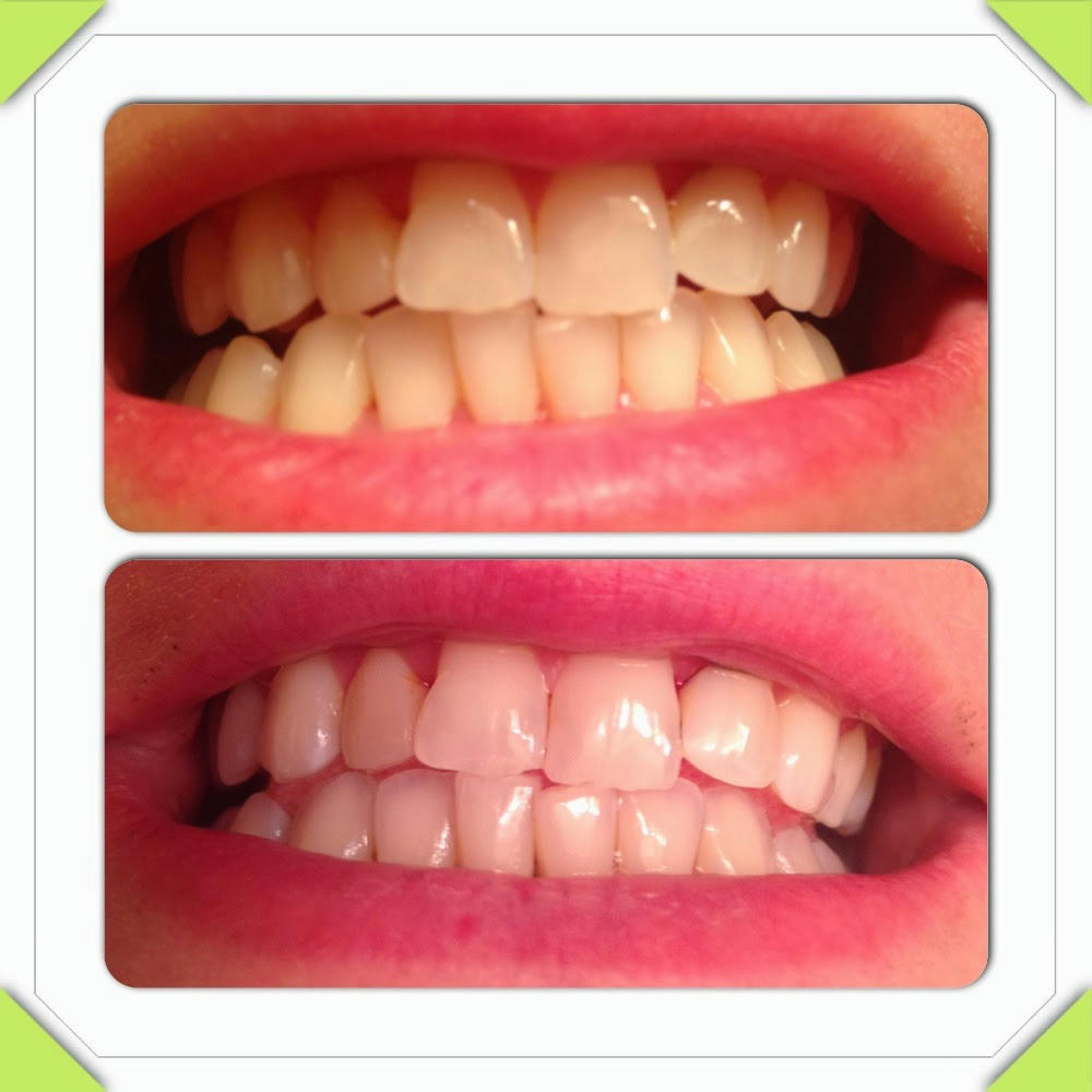 The Best Teeth Whiteners For A Perfect, Pearly-WhiteSmile pictures photo The Best Teeth Whiteners For A Perfect, Pearly-WhiteSmile