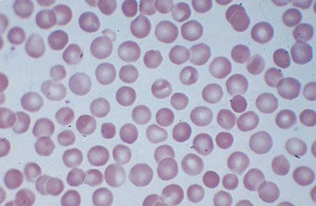 اسفروسیتوزیز . گلبول های هایپرکروماتیک کوچک