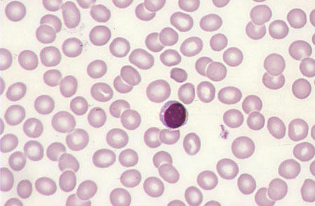 گلبول قرمز نرمال . لنفوسیت کوچک در وسط میدان