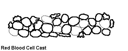 کست گلبول های قرمز در ادرار