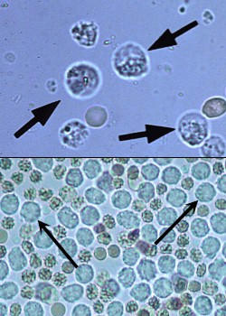 گلبول سفید در ادرار