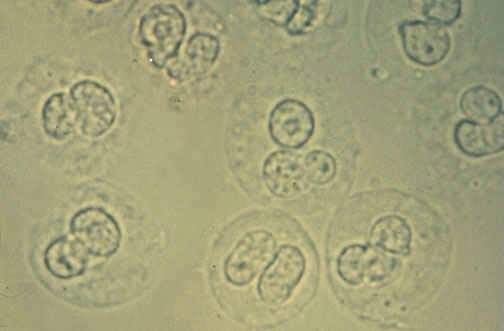 گلبول های سفید در ادرار