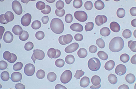 ماکروسیتوزیز