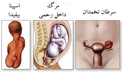 Alpha-Fetoprotein (AFP, Maternal Serum Alpha-Fetoprotein[MSAFP]), Triple Marker