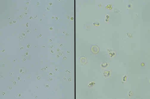 گلبول قرمز دی مورفیس در ادرار