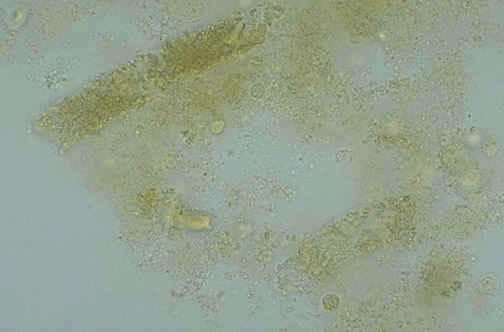 کست گرانولی در ادرار