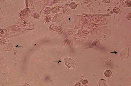 تریکوموناس واژینالیس