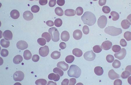 پلی کروموتوفیلی . گلبول های بزرگ با رنگ بنفش کم رنگ