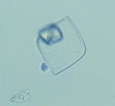 کریستال اسید اوریک