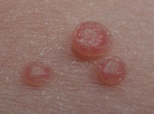Molusco contagioso o molluscum contagiosum
