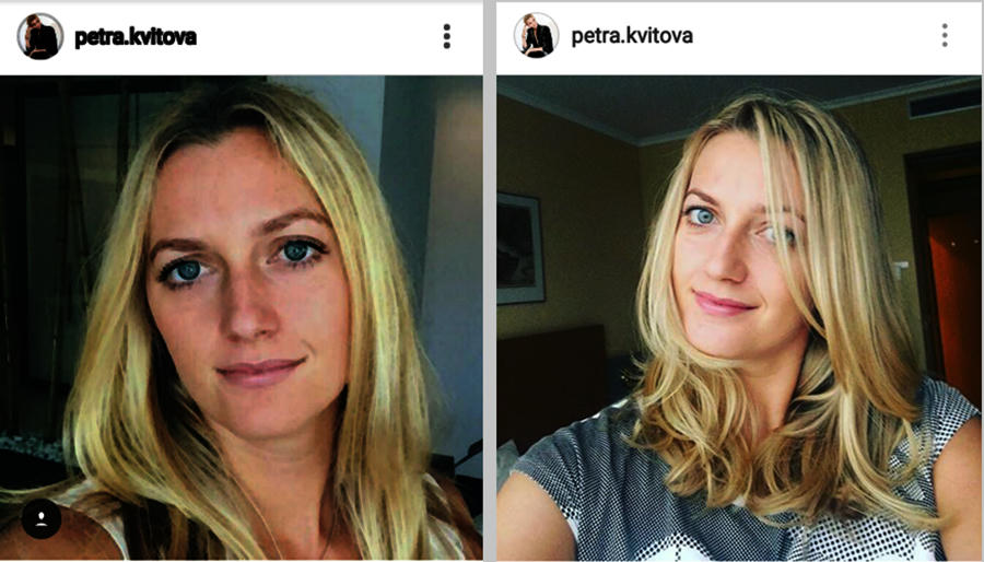 Operan por tres horas a tenista Petra Kvitova herida en un asalto