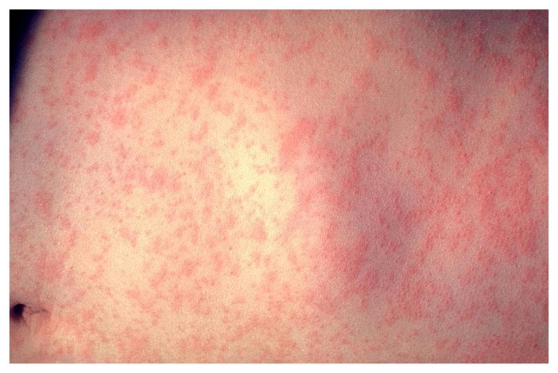 Reportan primer caso de sarampión autóctono en Argentina desde 2000