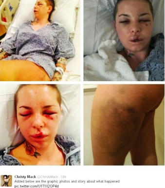  Las lesiones sufridas por Christy Mack fueron muy graves 